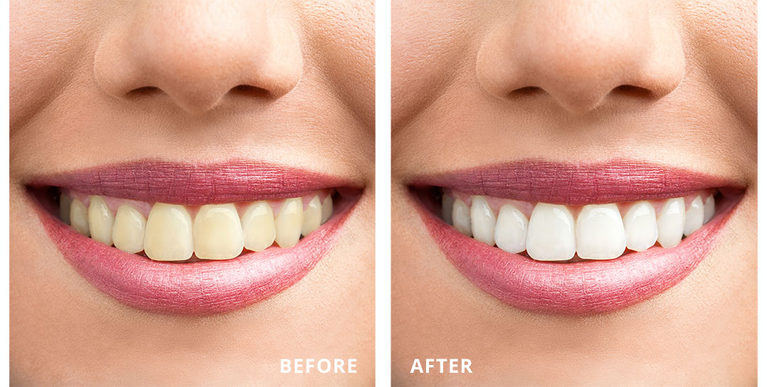 Woman's Teeth Before and After Sinsational Smile Teeth Whitening Treatment